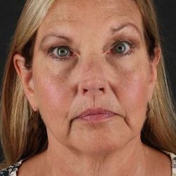 Fat Grafting To The Face Before & After Patient #4265