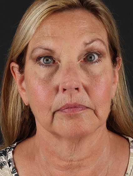 Fat Grafting To The Face Before & After Patient #4265