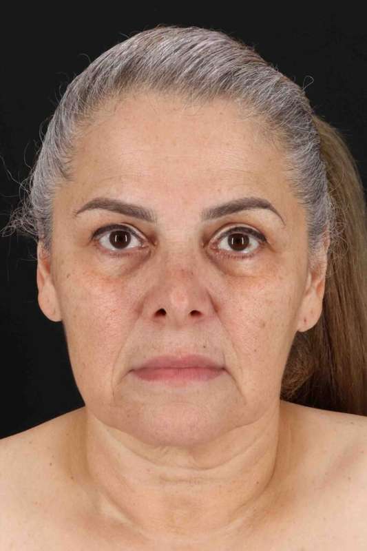 Fat Grafting To The Face Before & After Patient #4283