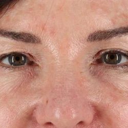 Blepharoplasty (Eyelid Surgery) Before & After Patient #4316