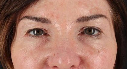 Blepharoplasty (Eyelid Surgery) Before & After Patient #4316