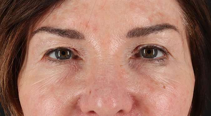 Blepharoplasty (Eyelid Surgery) Before & After Patient #4316