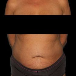 Abdominoplasty (Tummy Tuck) Before & After Patient #590