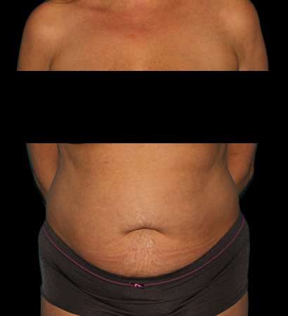 Abdominoplasty (Tummy Tuck) Before & After Patient #590