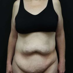 Abdominoplasty (Tummy Tuck) Before & After Patient #948