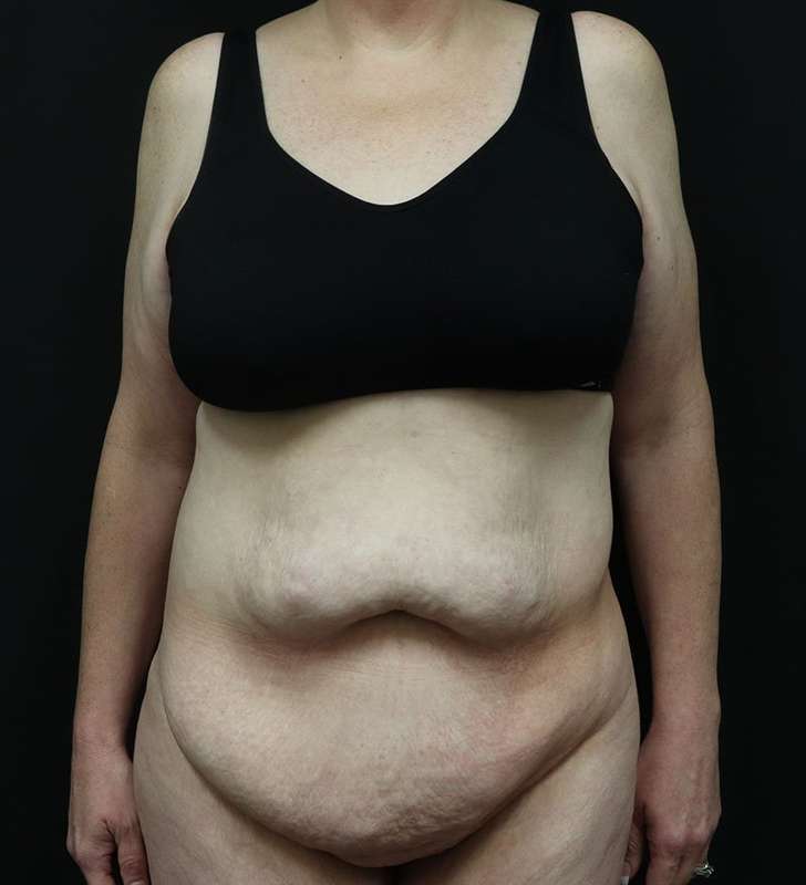Abdominoplasty (Tummy Tuck) Before & After Patient #948