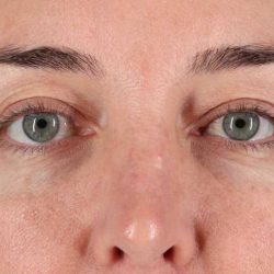 Blepharoplasty (Eyelid Surgery) Before & After Patient #4338