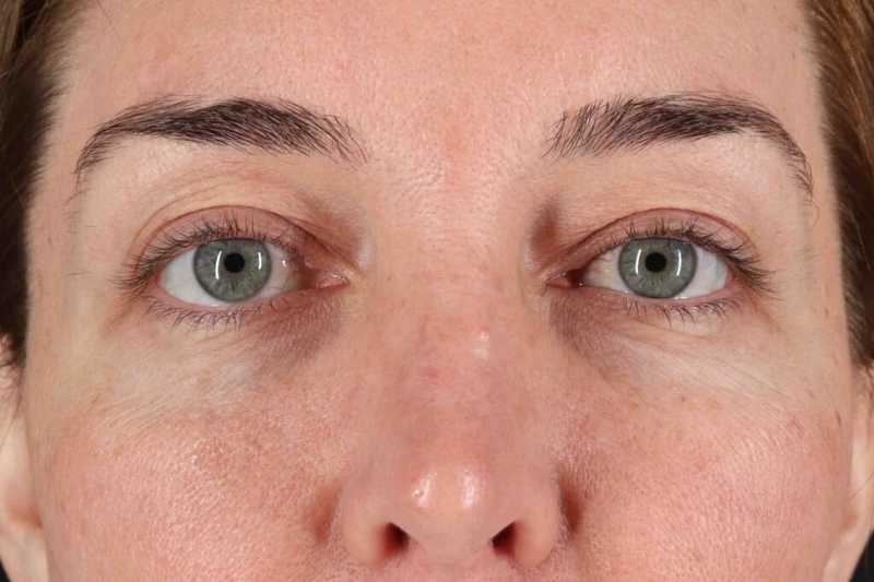 Blepharoplasty (Eyelid Surgery) Before & After Patient #4338
