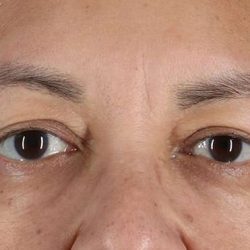 Blepharoplasty (Eyelid Surgery) Before & After Patient #4349