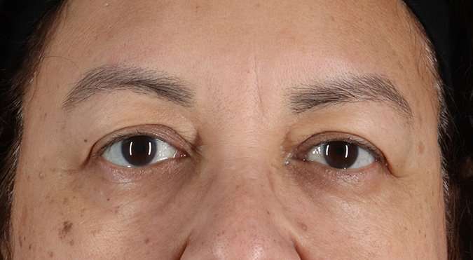 Blepharoplasty (Eyelid Surgery) Before & After Patient #4349