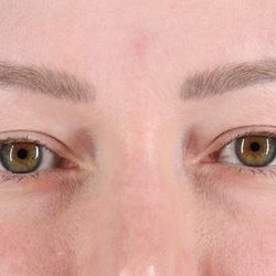 Blepharoplasty (Eyelid Surgery) Before & After Patient #4360