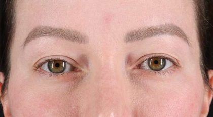 Blepharoplasty (Eyelid Surgery) Before & After Patient #4360