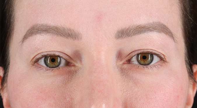 Blepharoplasty (Eyelid Surgery) Before & After Patient #4360