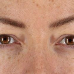 Blepharoplasty (Eyelid Surgery) Before & After Patient #4371