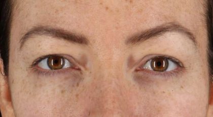 Blepharoplasty (Eyelid Surgery) Before & After Patient #4371