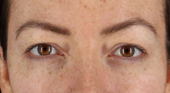 Blepharoplasty (Eyelid Surgery) Before & After Patient #4371