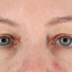 Blepharoplasty (Eyelid Surgery) Before & After Patient #4382