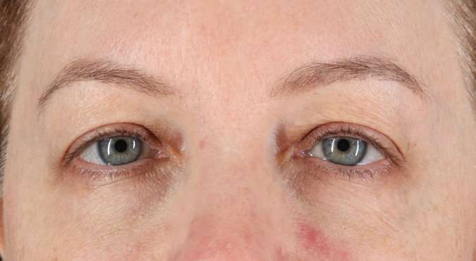 Blepharoplasty (Eyelid Surgery) Before & After Patient #4382