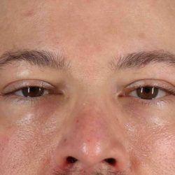 Blepharoplasty (Eyelid Surgery) Before & After Patient #4393