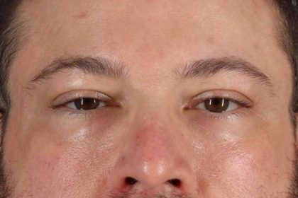 Blepharoplasty (Eyelid Surgery) Before & After Patient #4393
