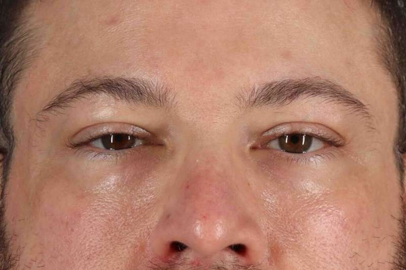 Blepharoplasty (Eyelid Surgery) Before & After Patient #4393