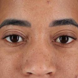 Blepharoplasty (Eyelid Surgery) Before & After Patient #4404