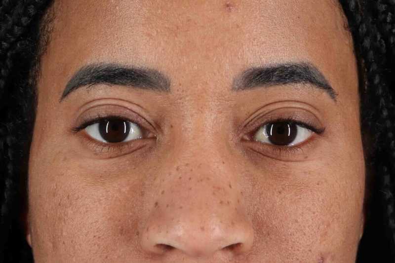 Blepharoplasty (Eyelid Surgery) Before & After Patient #4404