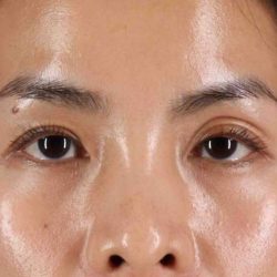 Blepharoplasty (Eyelid Surgery) Before & After Patient #4415