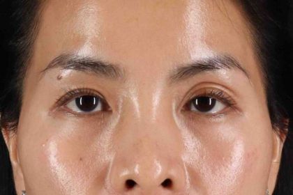 Blepharoplasty (Eyelid Surgery) Before & After Patient #4415