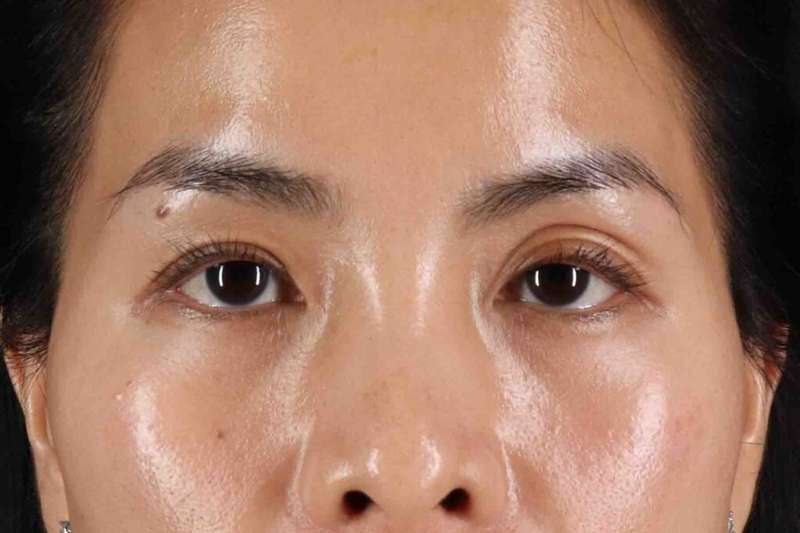Blepharoplasty (Eyelid Surgery) Before & After Patient #4415