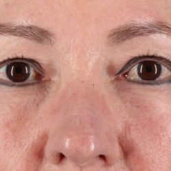 Blepharoplasty (Eyelid Surgery) Before & After Patient #4426