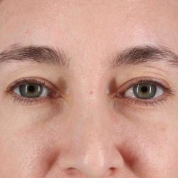 Blepharoplasty (Eyelid Surgery) Before & After Patient #4437