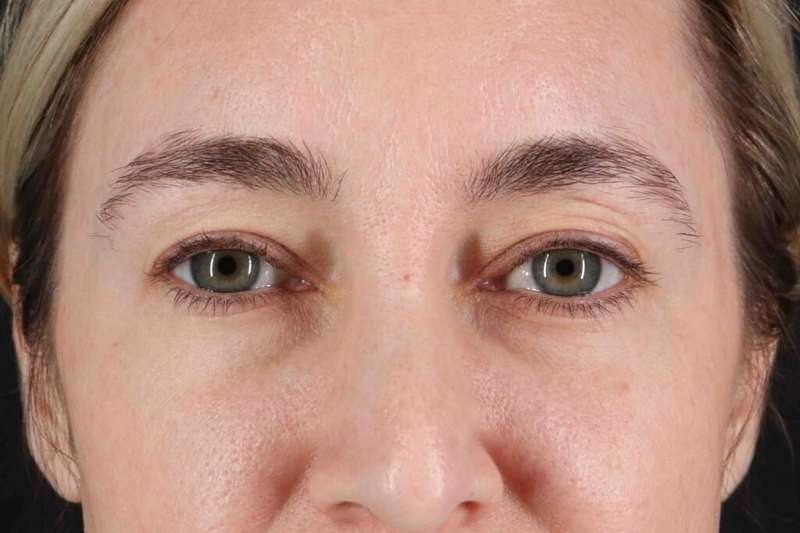 Blepharoplasty (Eyelid Surgery) Before & After Patient #4437