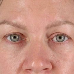 Blepharoplasty (Eyelid Surgery) Before & After Patient #4448