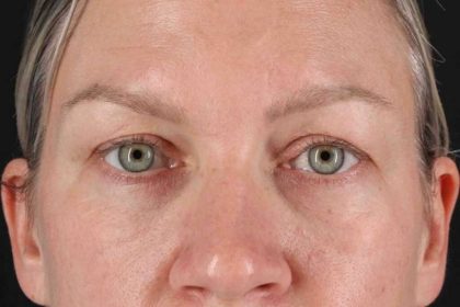Blepharoplasty (Eyelid Surgery) Before & After Patient #4448