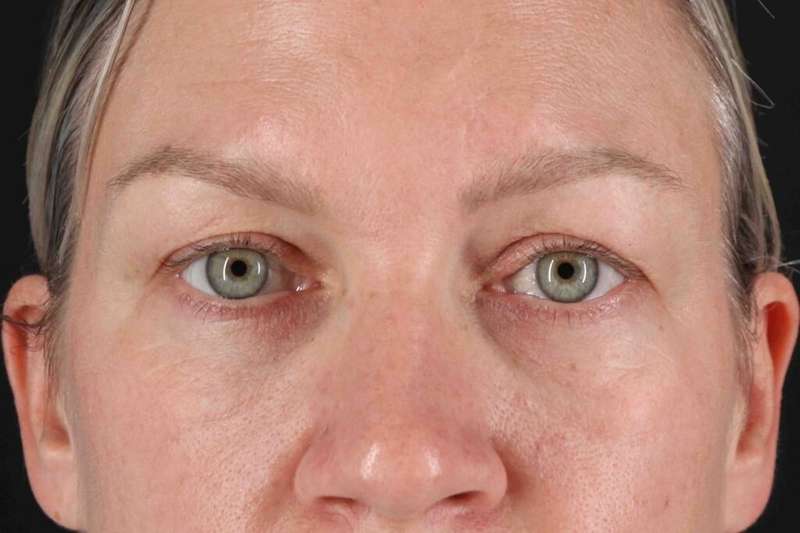 Blepharoplasty (Eyelid Surgery) Before & After Patient #4448