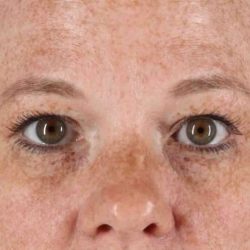 Blepharoplasty (Eyelid Surgery) Before & After Patient #4459
