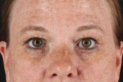 Blepharoplasty (Eyelid Surgery) Before & After Patient #4459