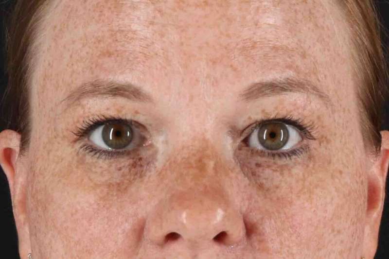 Blepharoplasty (Eyelid Surgery) Before & After Patient #4459
