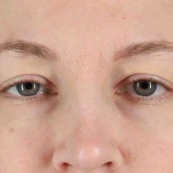 Blepharoplasty (Eyelid Surgery) Before & After Patient #4470