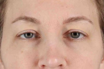 Blepharoplasty (Eyelid Surgery) Before & After Patient #4470