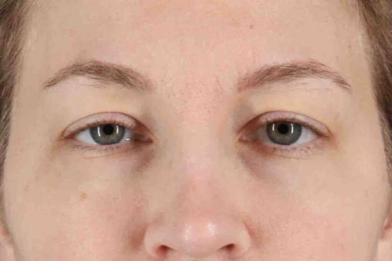 Blepharoplasty (Eyelid Surgery) Before & After Patient #4470