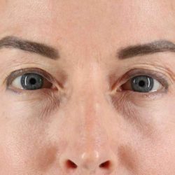 Blepharoplasty (Eyelid Surgery) Before & After Patient #4481