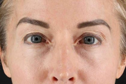 Blepharoplasty (Eyelid Surgery) Before & After Patient #4481