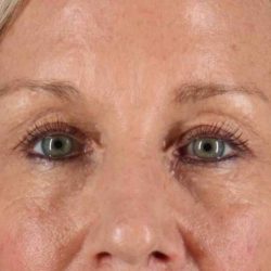 Blepharoplasty (Eyelid Surgery) Before & After Patient #4492