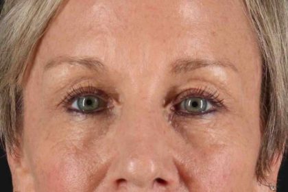 Blepharoplasty (Eyelid Surgery) Before & After Patient #4492