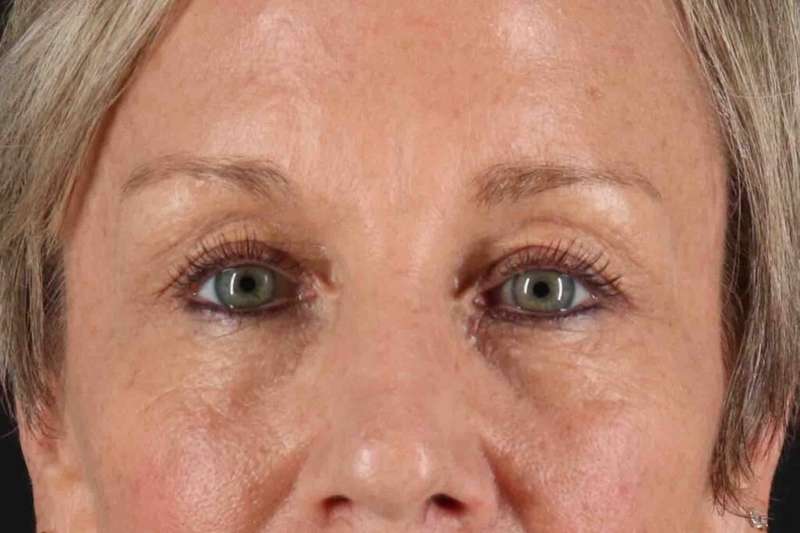 Blepharoplasty (Eyelid Surgery) Before & After Patient #4492