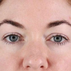 Blepharoplasty (Eyelid Surgery) Before & After Patient #4503