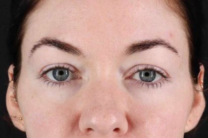 Blepharoplasty (Eyelid Surgery) Before & After Patient #4503