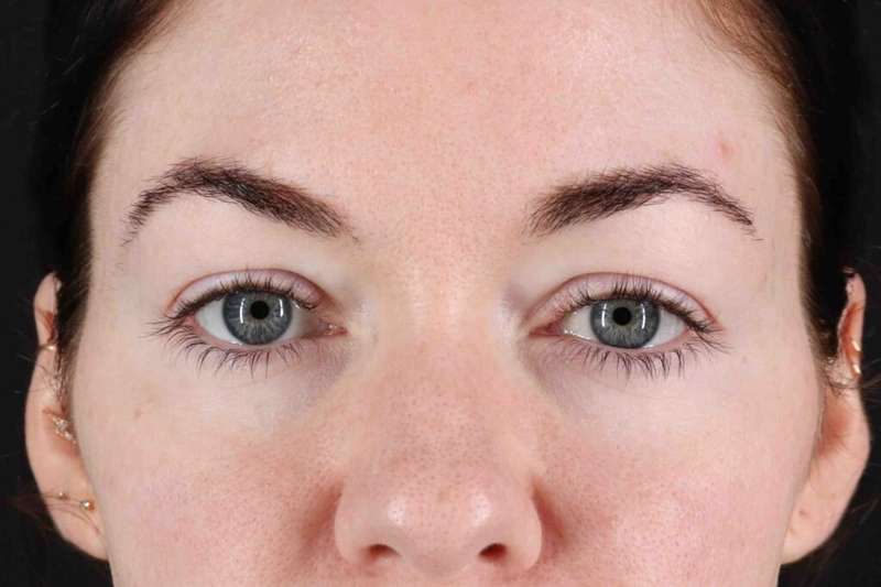 Blepharoplasty (Eyelid Surgery) Before & After Patient #4503